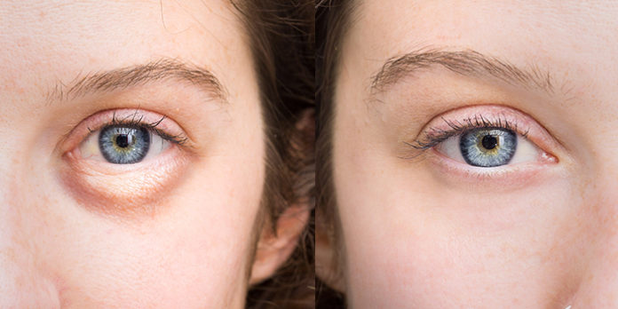 Cure and get rid of Puffy Eyes, Swollen Eyes, Bags Under the eyes Naturally with a Supplement