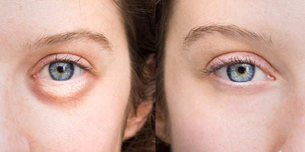 How To Get Rid of Puffy Eyes | Swollen Eyes | Bags Under Eyes Naturally - 18 Ways