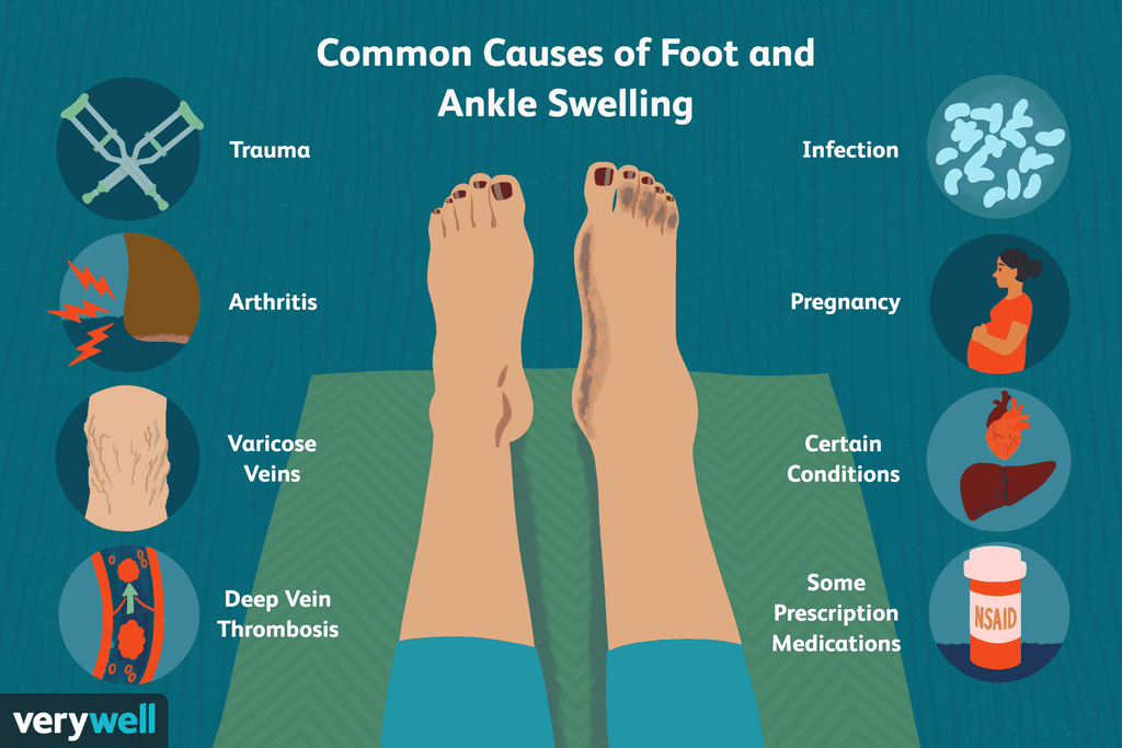 Swelling in Hands and Feet: Causes, Remedies, and the SwellNoMore Solution